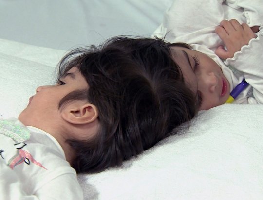 How doctors separated twins joined at the head -- after 50-hour surgery