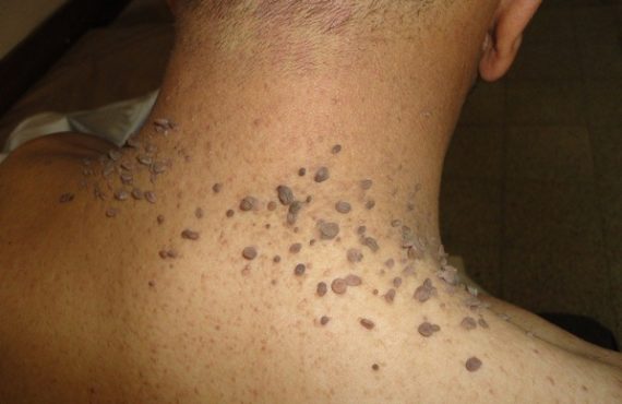 How to prevent skin tags: safe methods of removal