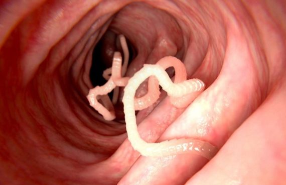 Why your child might be getting recurrent bouts of worms
