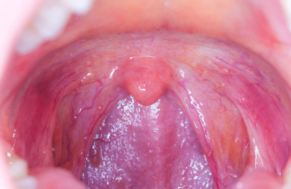 How oral sex could lead to throat cancer in partners through HPV