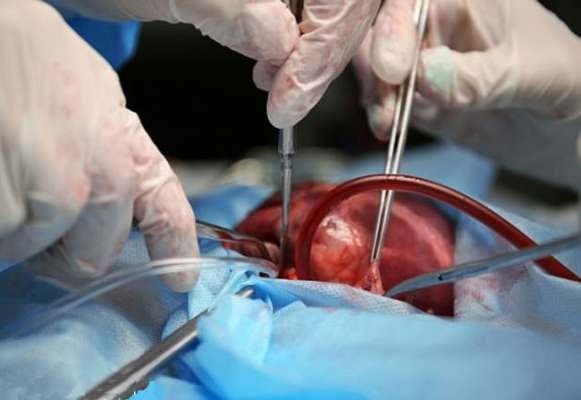 Doctors bring dead heart ‘back to life’ — in first of its kind surgery in the US
