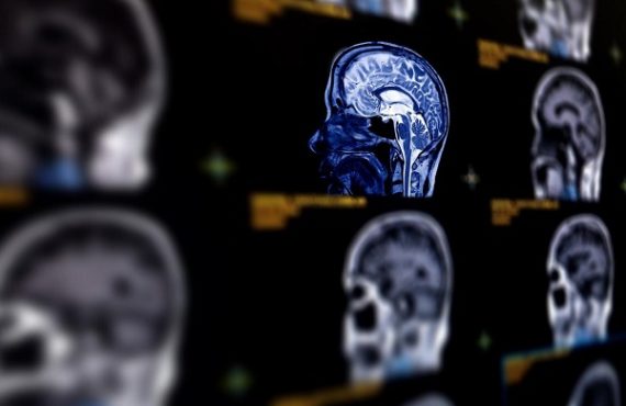 Scientists discover brain scan that could predict Alzheimer's -- years before symptoms