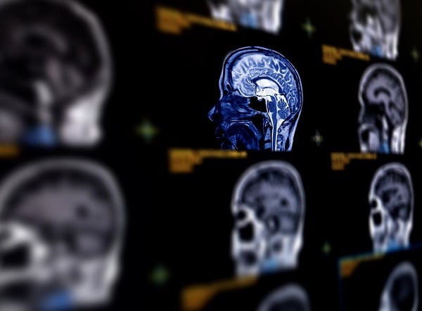 Scientists discover brain scan that could predict Alzheimer's -- years before symptoms