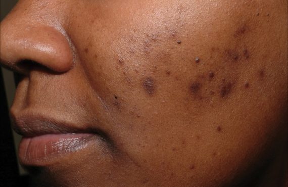 acne remedy