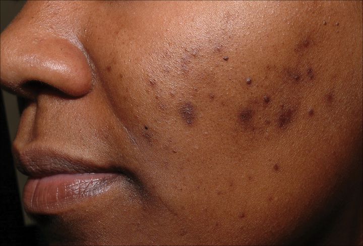 acne remedy