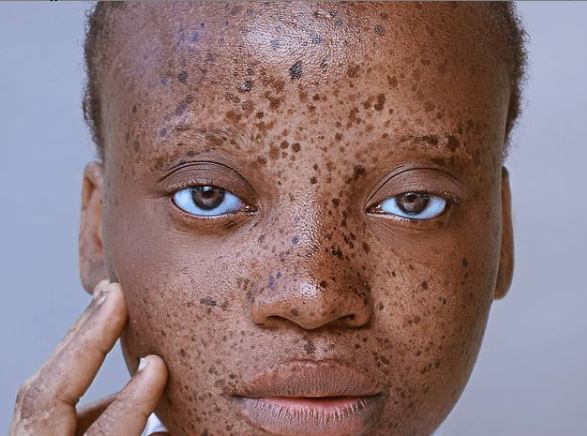 Rejection over my skin pushed me into modelling, says lady with vitiligo