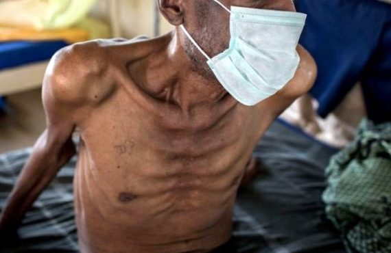 Study: Drug-resistant tuberculosis increasing in Nigeria