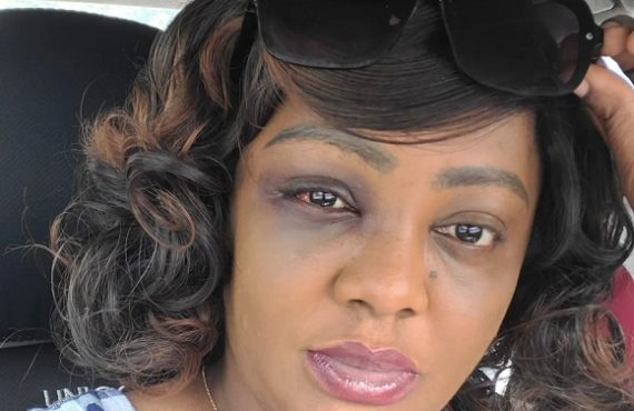 Helen Paul: How I suffered head injury after car accident