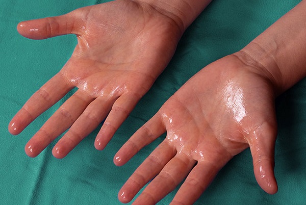 EXPLAINER: What to know about sweaty palms